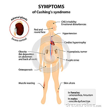 Cushingâ€™s disease and syndrome Vector Illustration